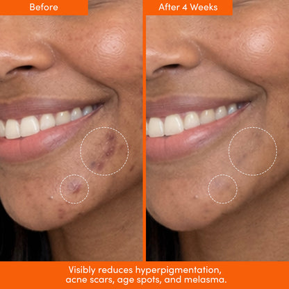 MANE SQUEEZE Tinted SPF + Dark Spot Serum Bundle - Shaketea