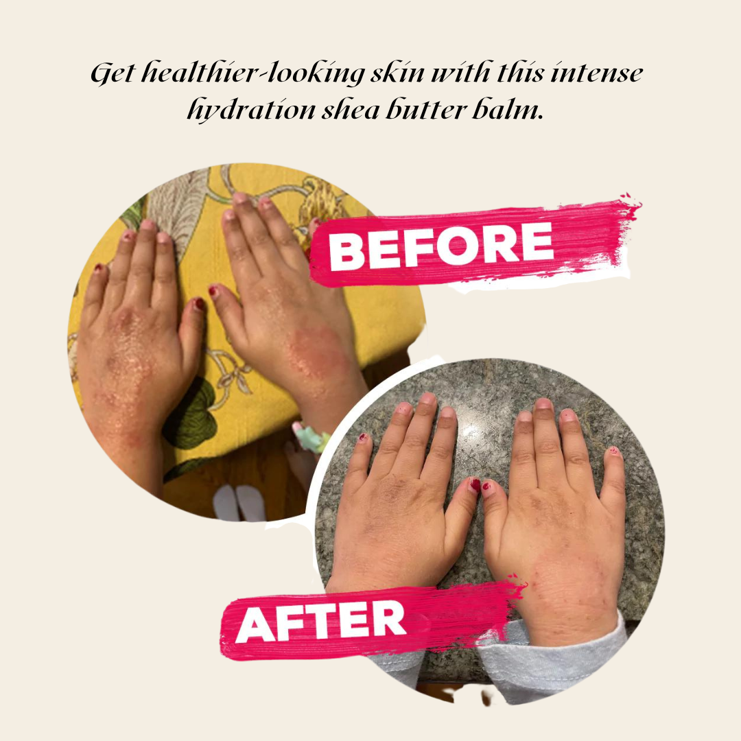 Ultra-Rich Body Balm for Very Dry, Sensitive Skin – Deep Overnight Hydration, Nut-Free