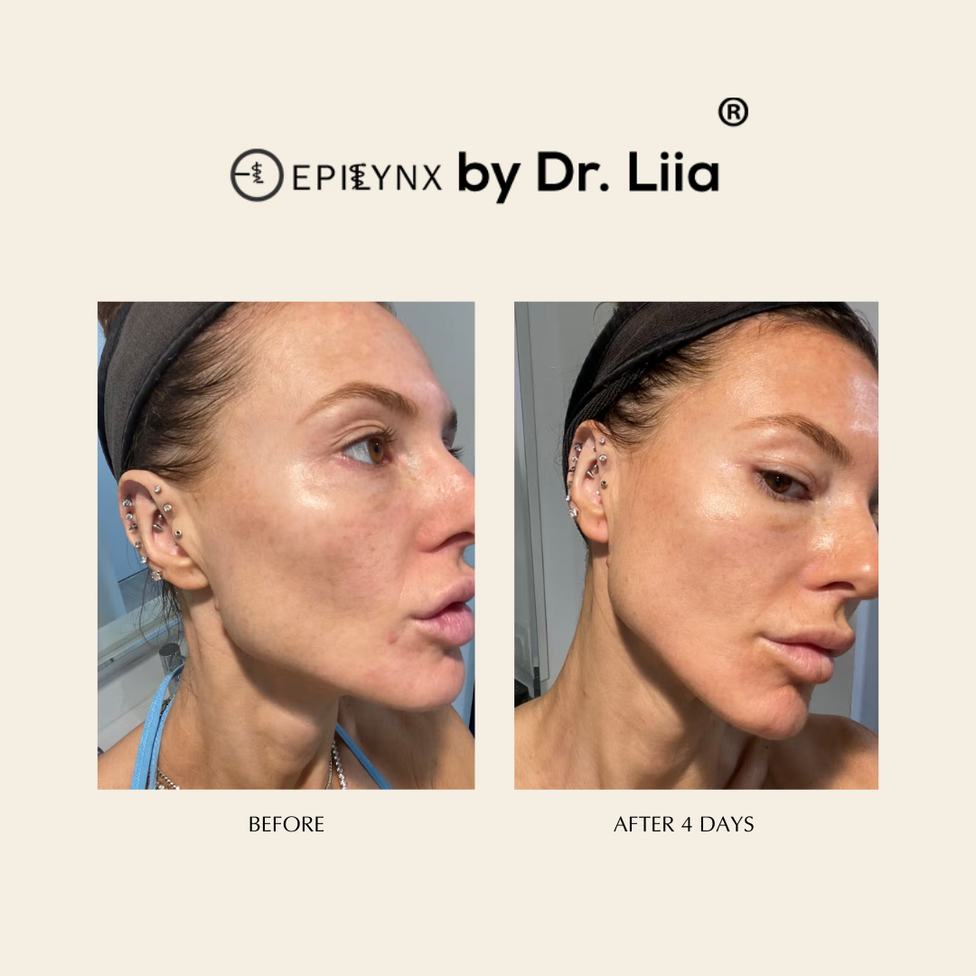 Pore Refining Serum for Redness & Acne Scars – Calms Reactive Skin, Fragrance-Free
